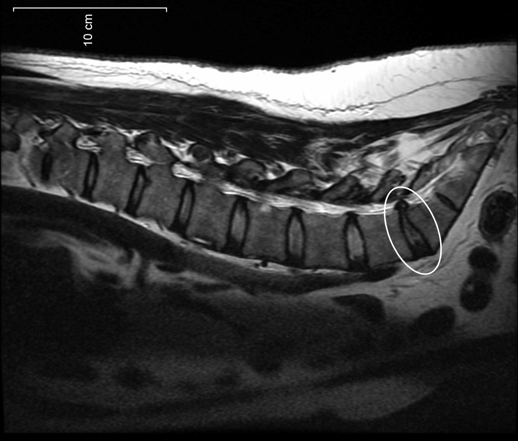 Consult Experts In Disc Protrusion Singapore